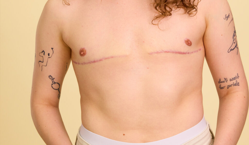 top-surgery-abroad-cost